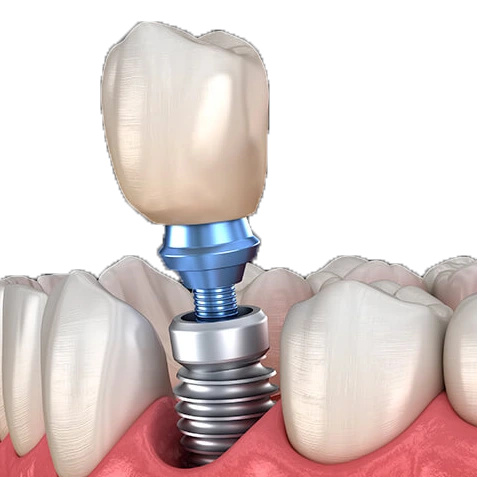 Implantes