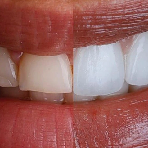 Lentes de Contato Odontológica